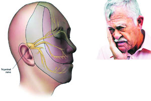 चेहऱ्याच्या नसेची जीवघेणी कळ – ट्रायजेमिनल न्यूरॉल्जिया चेहऱ्याच्या नसेची जीवघेणी कळ – ट्रायजेमिनल न्यूरॉल्जिया