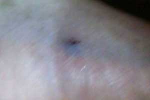 विसर्जनाच्या वेळी ५४ जणांना माशांचा चावा विसर्जनाच्या वेळी ५४ जणांना माशांचा चावा