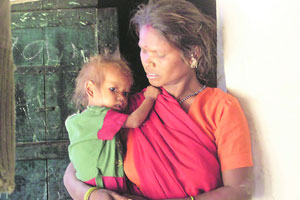 बालकुपोषण – पुढची आव्हाने बालकुपोषण – पुढची आव्हाने