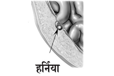 हर्निया