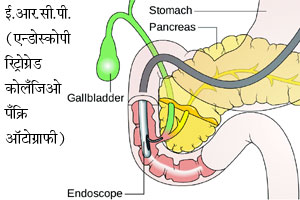 एन्डोस्कोपीतील नवीन उपचार पद्धती एन्डोस्कोपीतील नवीन उपचार पद्धती