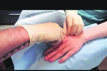 महापालिका रुग्णालयात हाताच्या प्रत्यारोपणाची चाचपणी महापालिका रुग्णालयात हाताच्या प्रत्यारोपणाची चाचपणी