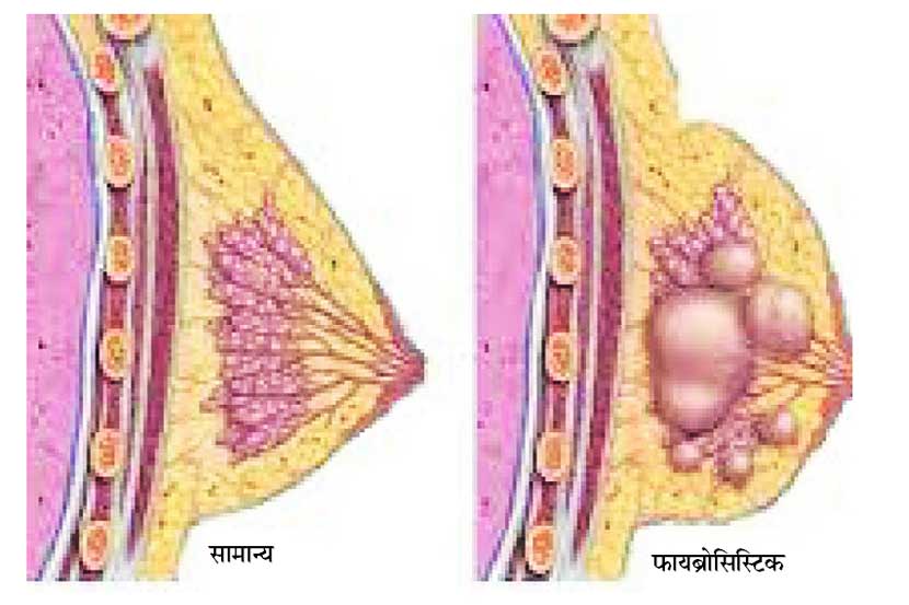 प्रकृ‘ती’ : स्तनांचे आजार
