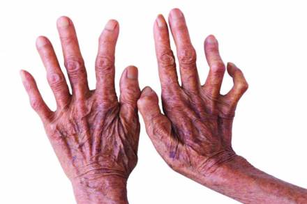 नागपूर जिल्ह्य़ात कुष्ठरुग्णांच्या संख्येत घट नागपूर जिल्ह्य़ात कुष्ठरुग्णांच्या संख्येत घट