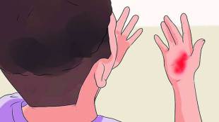 Remedies for Burns
