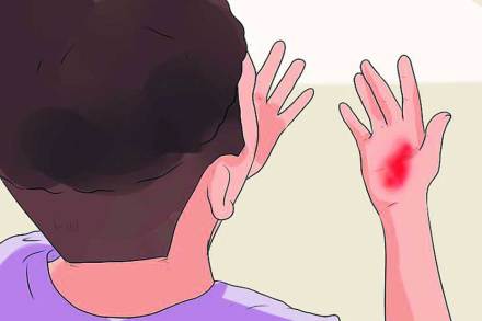 Remedies for Burns