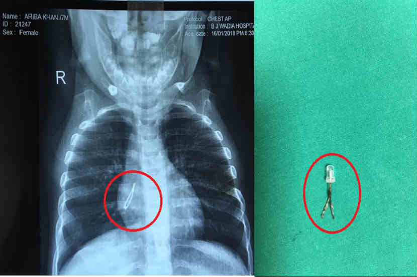 …आणि ७ महिन्यांच्या बाळाने गिळला एलईडी बल्ब