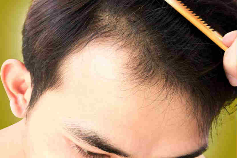 टक्कल पडतंय? हे उपाय करुन बघा