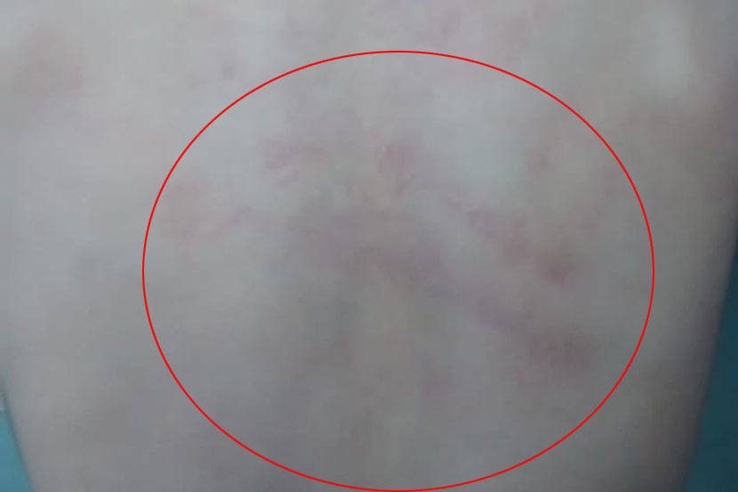कडलग यांनी केलेली मारहाण इतकी अमानुष होती की मुलाच्या पाठीवर त्याचे वळ उमटले. 