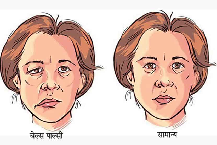 आजारांचे कुतूहल : बेल्स पाल्सी