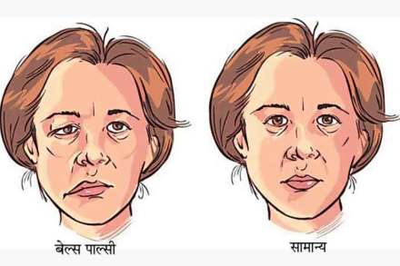 आजारांचे कुतूहल : बेल्स पाल्सी