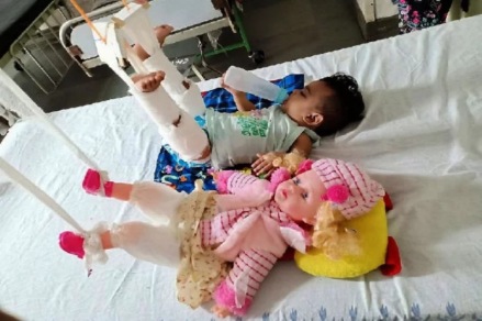 अनोखं नातं ! चिमुकलीवर उपचारासाठी बाहुलीला करावं लागलं प्लास्टर, डॉक्टरही हैराण