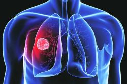 फुप्फुसाच्या कर्करोगाशी लढण्यासाठी…