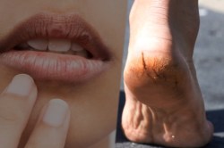 थंडीमुळे फाटलेले ओठ आणि पायांच्या भेगांसाठी काय कराल?