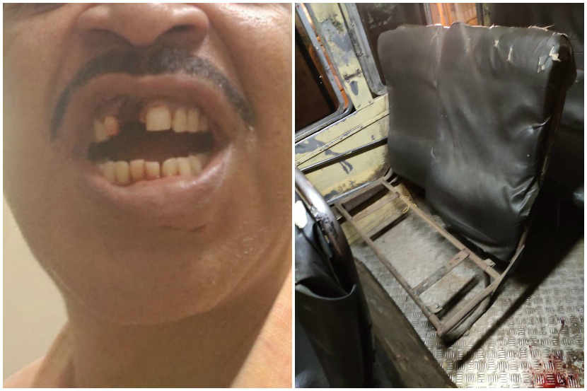 पुणे : भरधाव एसटी गतिरोधकावर आदळल्याने एका प्रवाशाचा दात तुटला आहे.