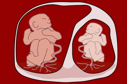 स्वमग्नता असलेल्या जुळ्यांच्या लक्षणांच्या तीव्रतेत फरक