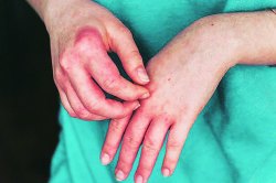 अॅलर्जी : आडाख्यांपलीकडची ओळख