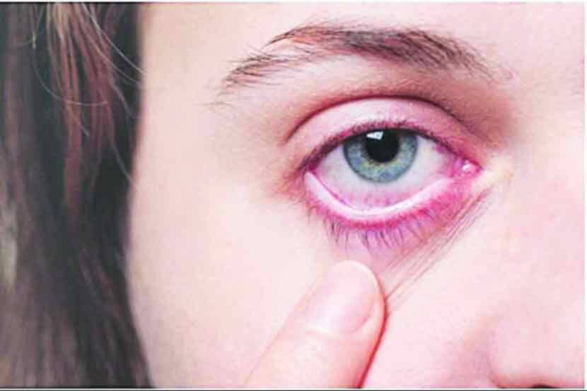 कल्याण-डोंबिवलीत म्युकरमायकोसिसचे सहा रुग्ण