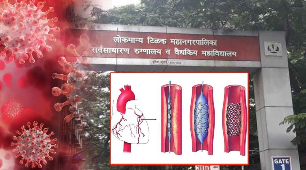 heart surgeries in sion hospital