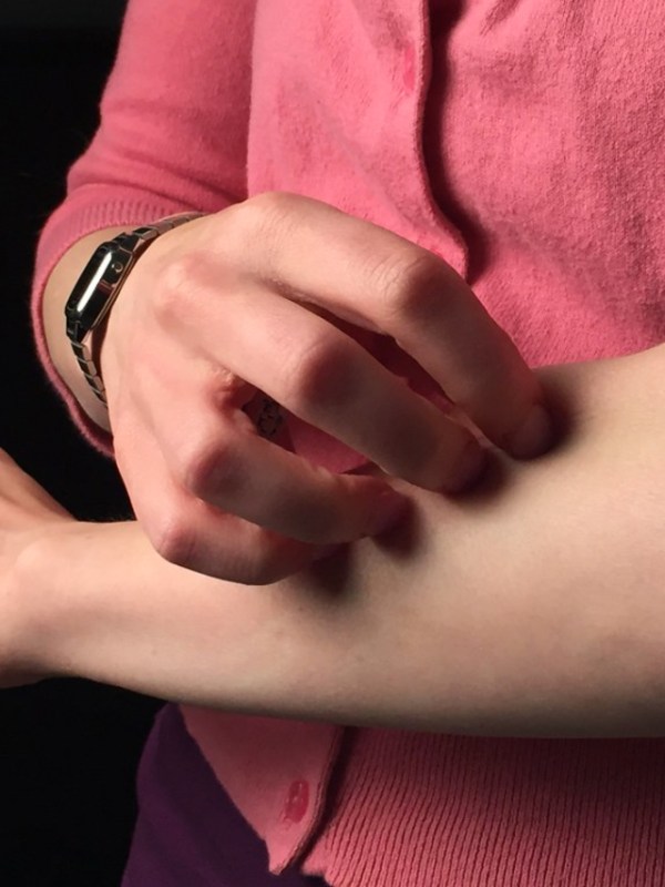 Skin Itching Home Remedies