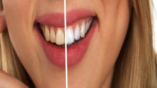 Dental Care Tips