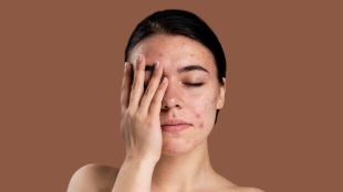 pimple skin freepik