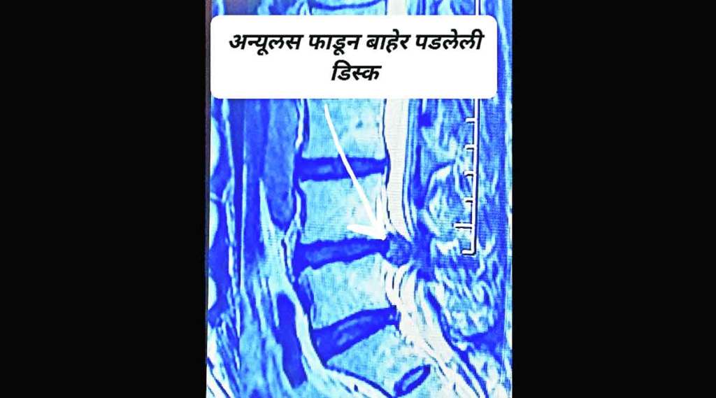 चेतासंस्थेची शल्यकथा : ‘डिस्क’च्या शस्त्रक्रियेचा इतिहास