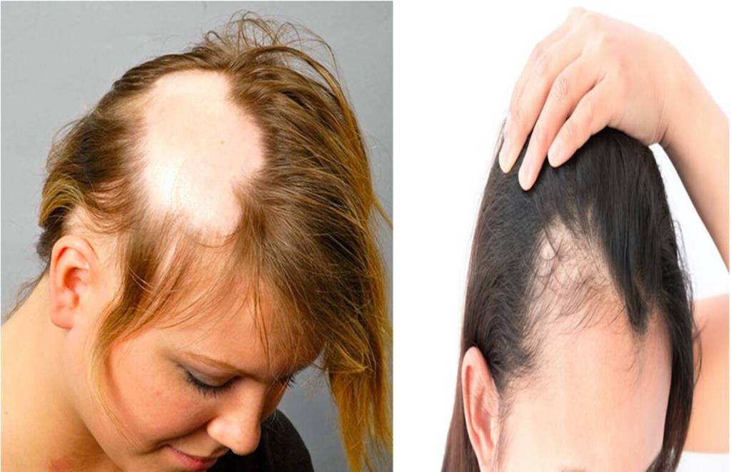 Hairfall
