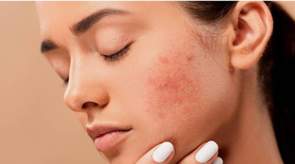 baba ramdev yoga asanas to treat pimples