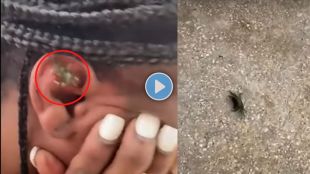 crab stuck inside a woman ear