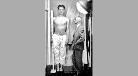 १९२० च्या दशकात ग्रोथ हॉर्मोन वाढलेल्या व्यक्तीबरोबर डॉ. हार्वे कुशिंग १९२० च्या दशकात ग्रोथ हॉर्मोन वाढलेल्या व्यक्तीबरोबर डॉ. हार्वे कुशिंग