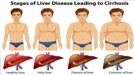 Fatty Liver, Fatty Liver,