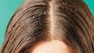 dandruff 1