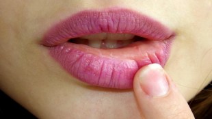 Lip allergies can be removed at home; These simple tips can be helpful