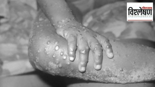 monkeypox
