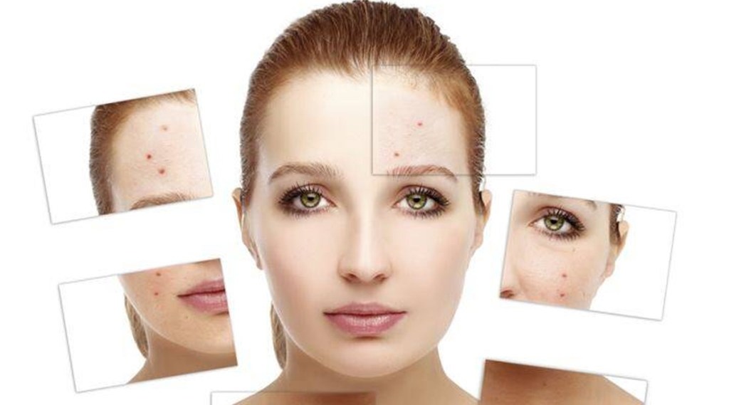 Skin Care Tips: Do you have acne on your face? Take care this way