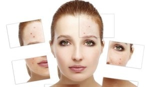 Skin Care Tips: Do you have acne on your face? Take care this way