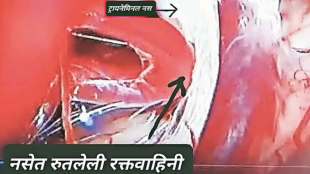 trigeminal neuralgia pain