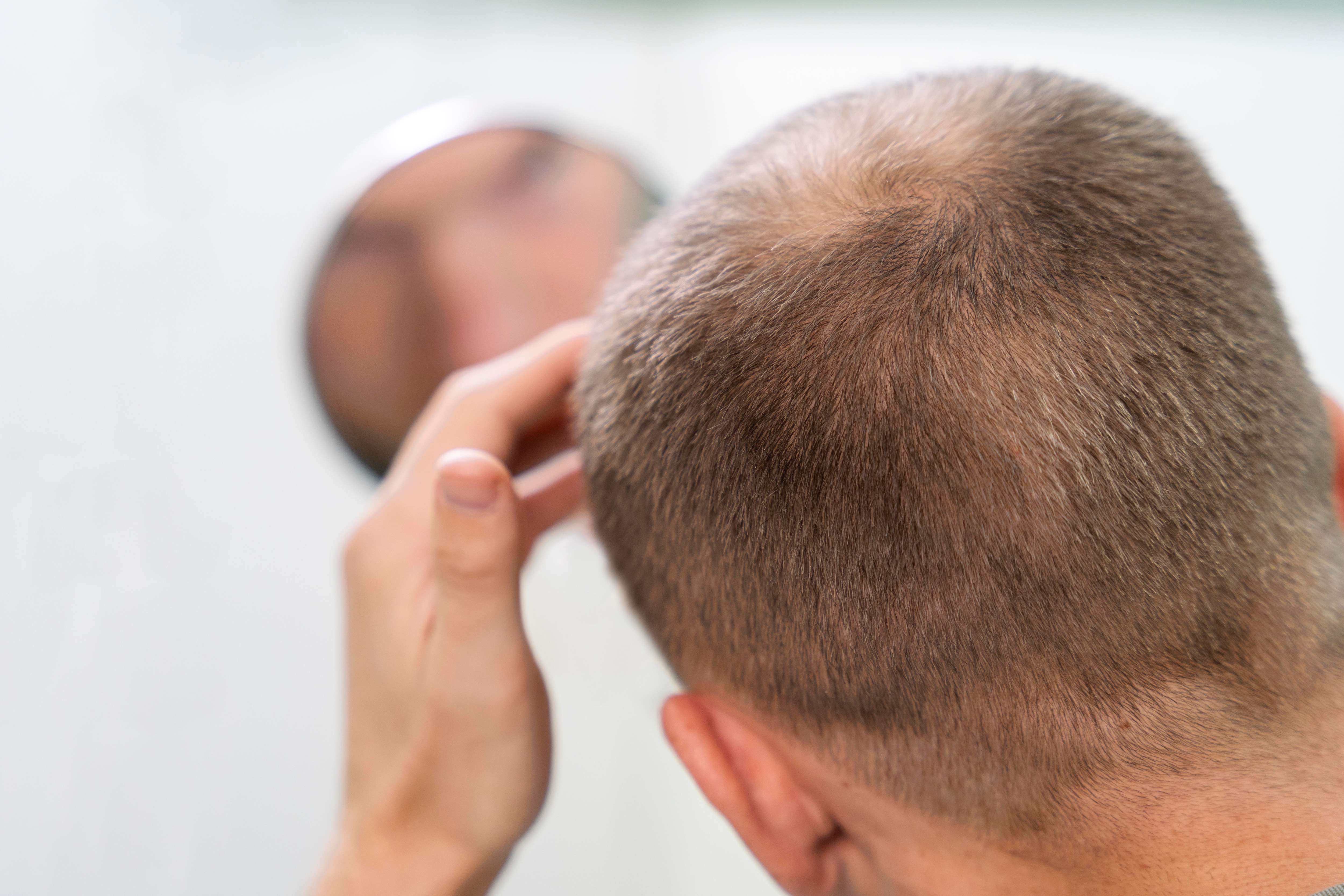 Onion will cure baldness problem