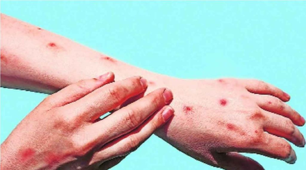 monkeypox