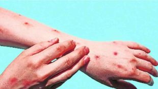 monkeypox