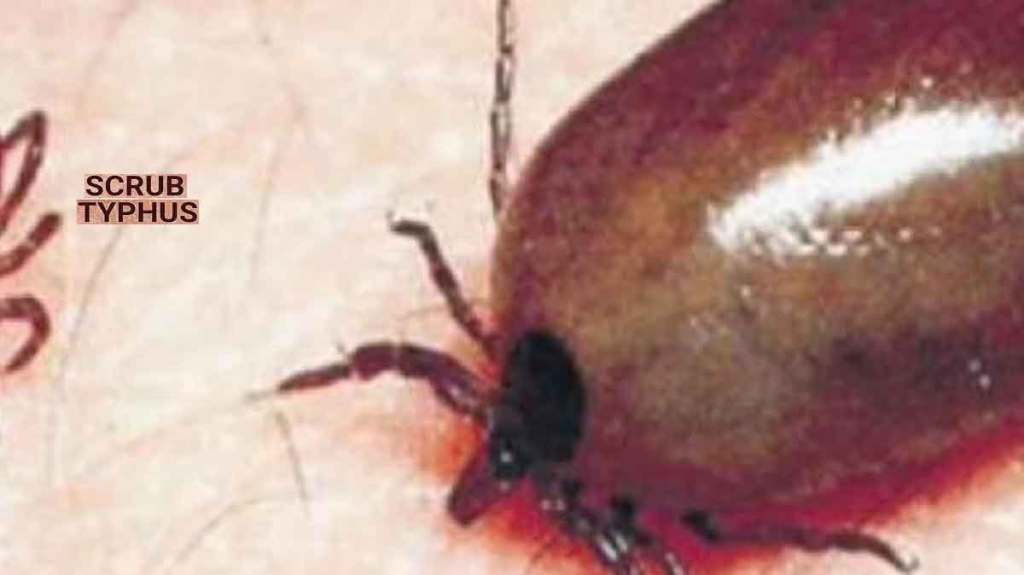 scrub typhus disease in buldhana scrub typhus disease in buldhana