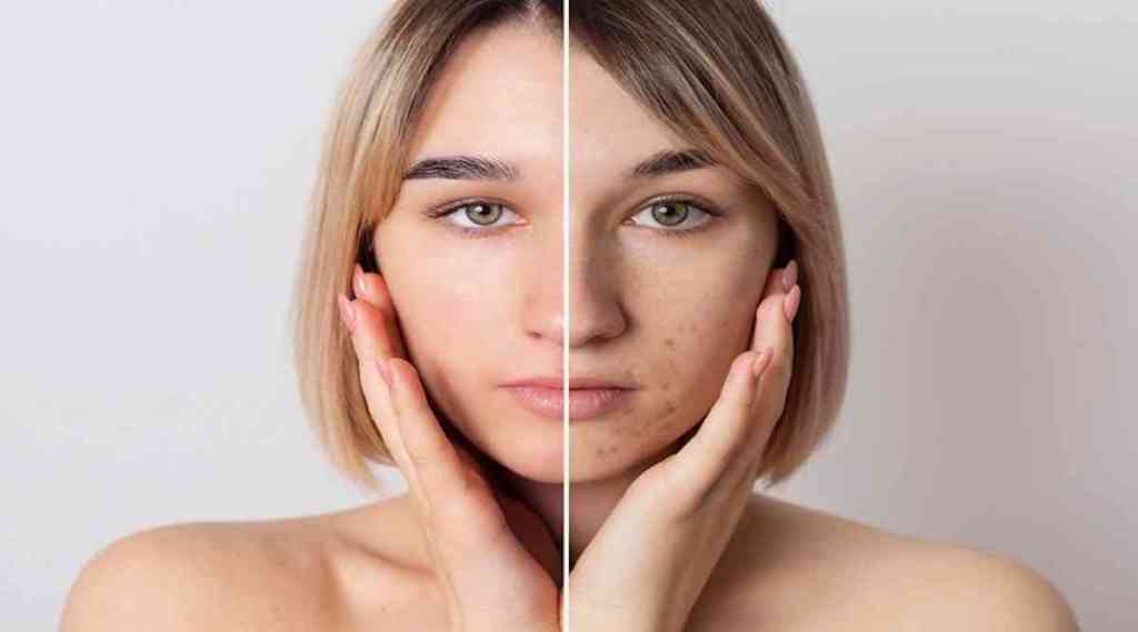 Baking soda Remedi for Pimples