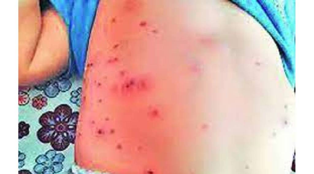 Scrub typhus