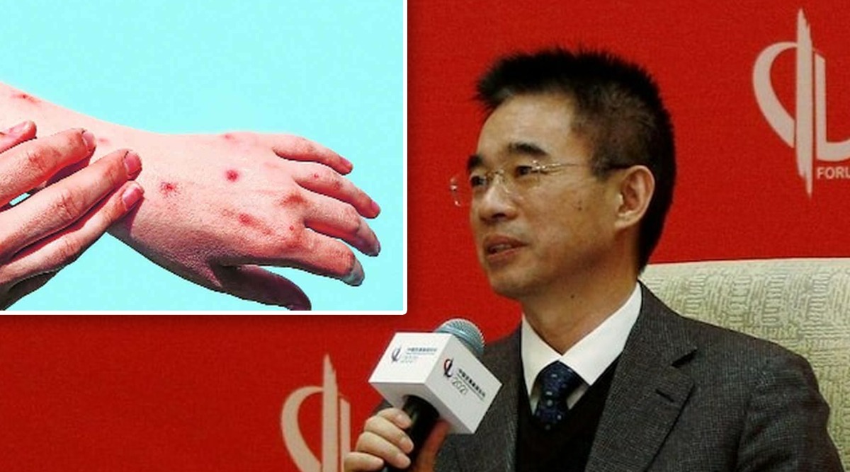 first monkeypox case found in china official warned not to touch foreigners