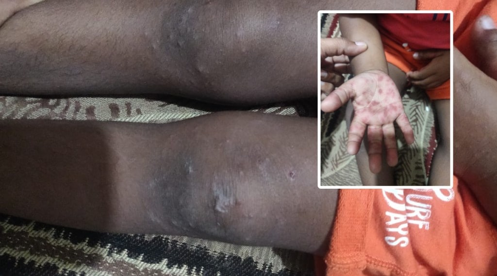 Chickenpox like rash on hands feet mouth in children in Nagpur Chickenpox like rash on hands feet mouth in children in Nagpur