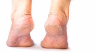 Cracked heels in winter