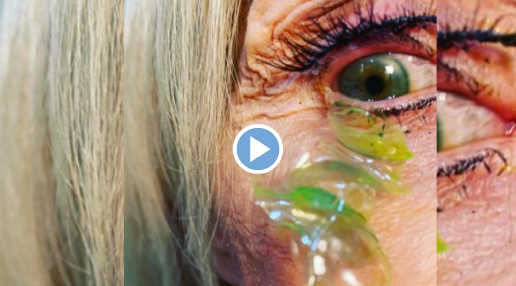 Viral video Doctor Removes 23 contact lenses from womens eye Know How To Use lenses