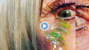 Viral video Doctor Removes 23 contact lenses from womens eye Know How To Use lenses