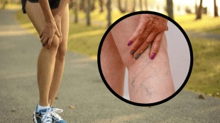 Varicose veins Swelling in feet blood vessels turn blue green how to cure impure blood Ayurvedic Treatment